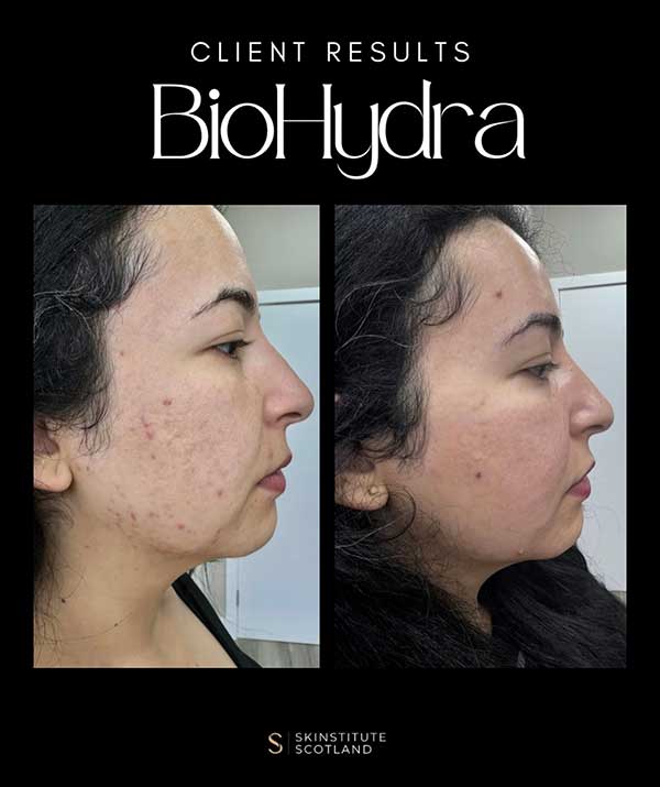 Hydrafacial